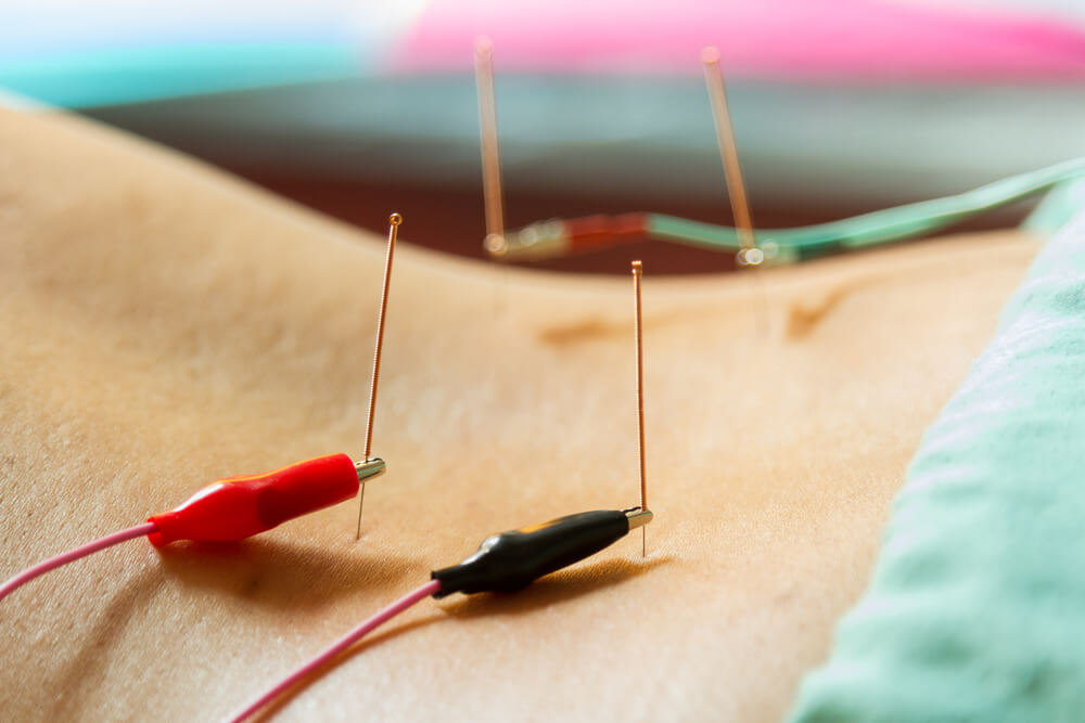 What Is Electro-Acupuncture?